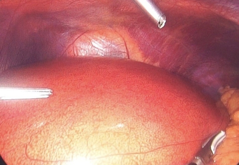 Ngó lơ mỡ nội tạng coi chừng… mất mạng